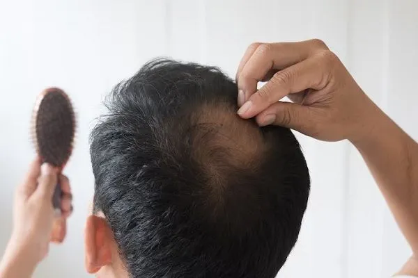 Difenciprona, inmunoterapia para alopecia areata 3 Difenciprona, inmunoterapia para alopecia areata