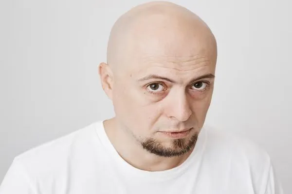 Inhibidores de Jak para alopecia areata 2 Inhibidores de Jak para alopecia areata