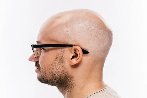 Inhibidores de Jak para alopecia areata