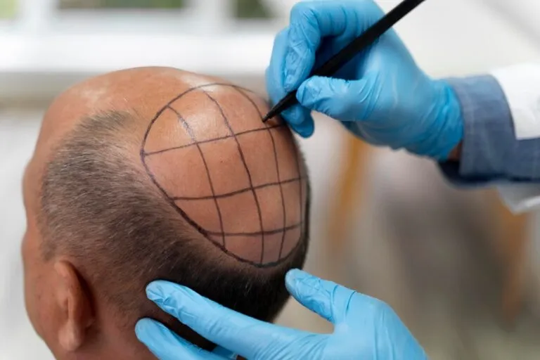 L’augmentation des demandes de greffe de cheveux : les raisons d’un succès mondial 5 L’augmentation des demandes de greffe de cheveux : les raisons d’un succès mondial