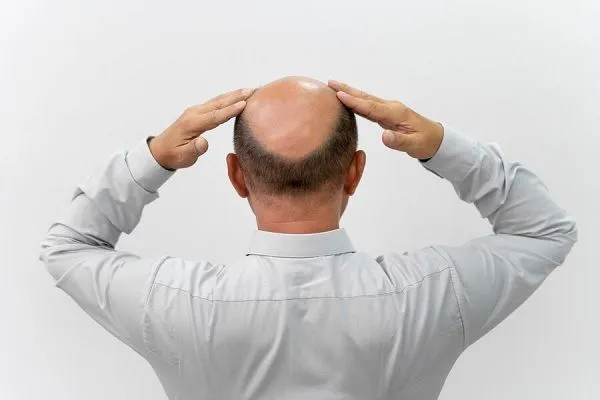Mes cheveux tombent de façon disproportionnée 5 Mes cheveux tombent de façon disproportionnée