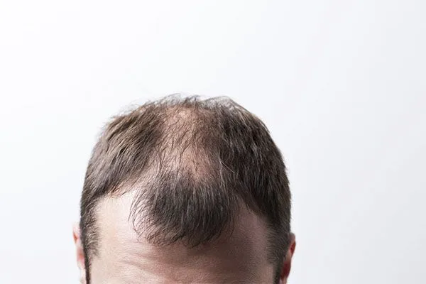Perte de cheveux pendant la chimiothérapie