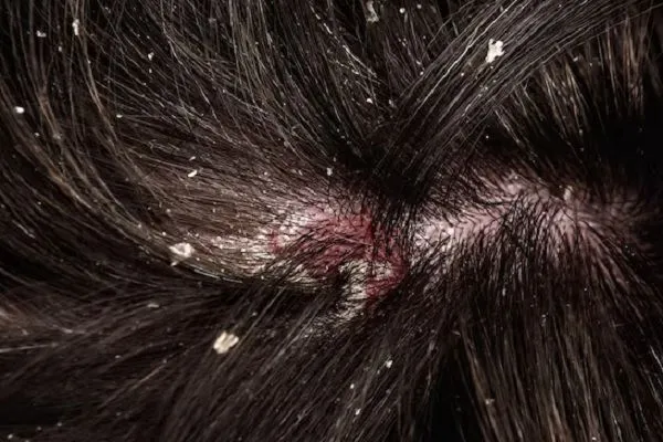 Problemas capilares distintos a la alopecia 2 Problemas capilares distintos a la alopecia
