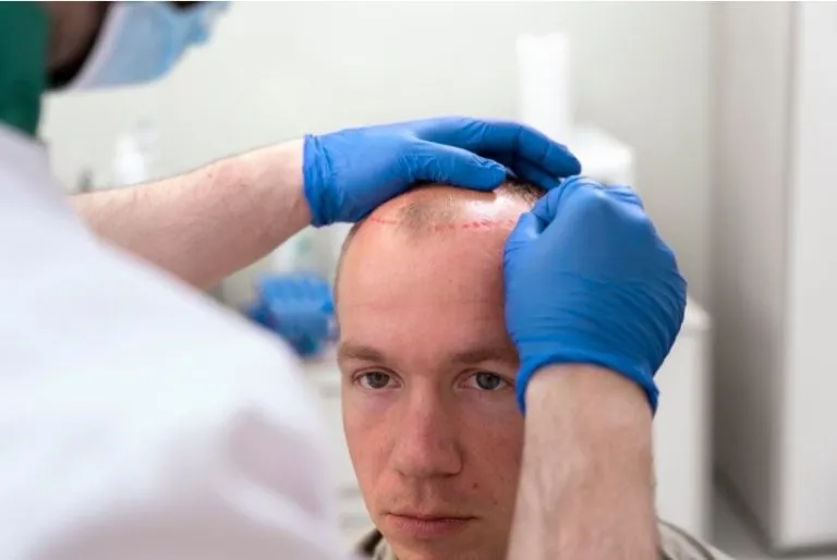 Dermatologue greffe de cheveux : quel est son rôle avant, pendant et après l’intervention ?