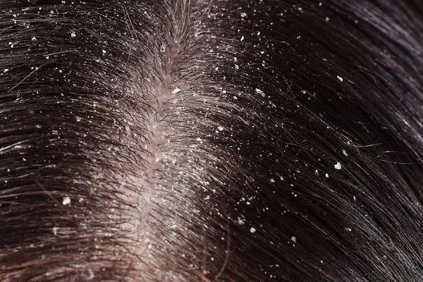 Remedios naturales para la dermatitis seborreica