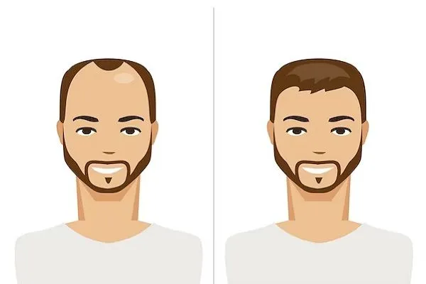 Sistema de integración capilar ¿En qué consiste?