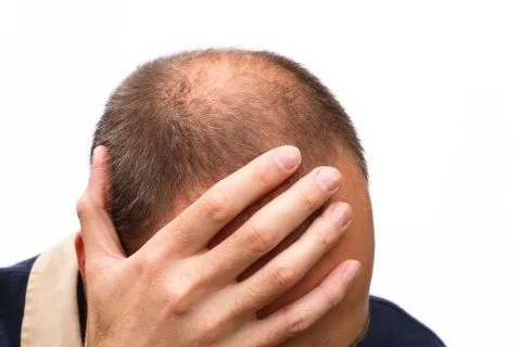 Consecuencias de la alopecia en hombres y mujeres