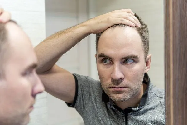 Todo sobre la alopecia: causas, tipos, diagnóstico y tratamientos médicos 4 Todo sobre la alopecia: causas, tipos, diagnóstico y tratamientos médicos