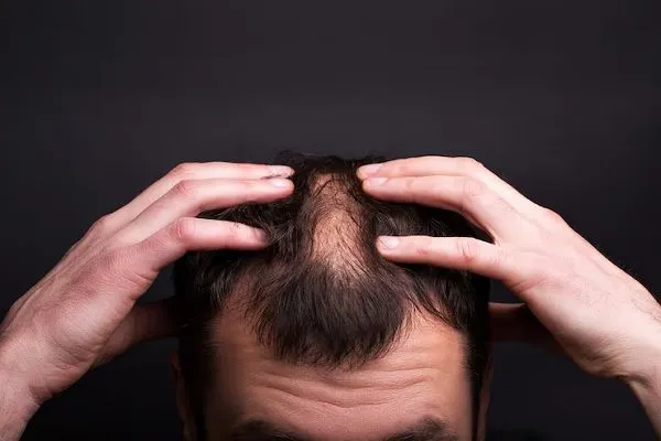 Consejos para personas con alopecia areata