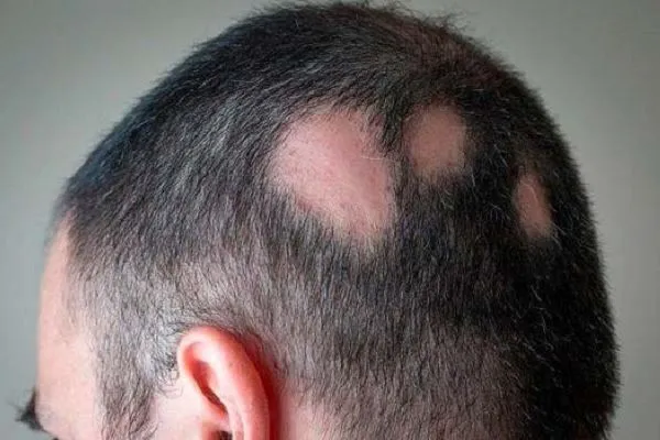 Alopecia areata: qué es, causas y tratamientos