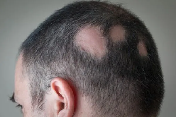 Olumiant para la alopecia areata 2 Olumiant para la alopecia areata