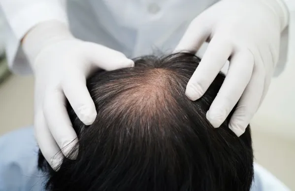 Guía de la Alopecia: Causas reales y tratamientos médicos efectivos 2 Guía de la Alopecia: Causas reales y tratamientos médicos efectivos