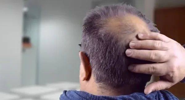 Las consecuencias psicológicas de la alopecia y microtrasplantes