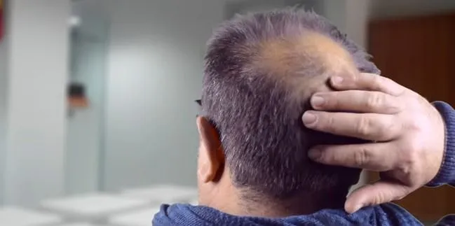 Las consecuencias psicológicas de la alopecia y microtrasplantes 1 Las consecuencias psicológicas de la alopecia y microtrasplantes