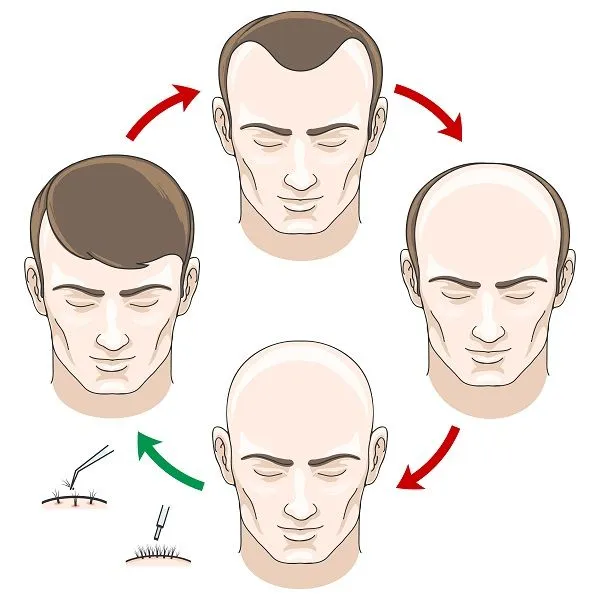 La alopecia uno de los mayores temores actualmente
