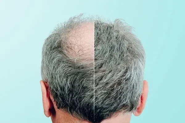 Minoxidil 5, ¿qué es y cómo usar para frenar la caída del pelo?