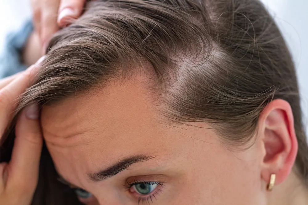 Problemas psicológicos que pueden derivar de la alopecia 3 Problemas psicológicos que pueden derivar de la alopecia