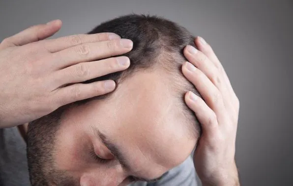 Consecuencias psicológicas de la alopecia