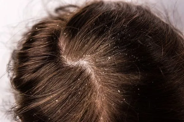 ¿Qué es la alopecia seborreica? 3 ¿Qué es la alopecia seborreica?
