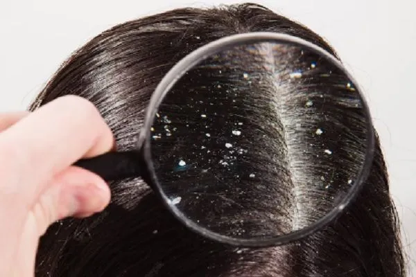 ¿Qué es la alopecia seborreica? 2 ¿Qué es la alopecia seborreica?