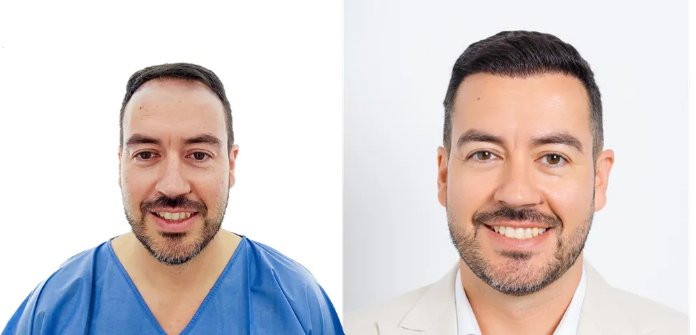 Guía de la Alopecia: Causas reales y tratamientos médicos efectivos 4 Guía de la Alopecia: Causas reales y tratamientos médicos efectivos