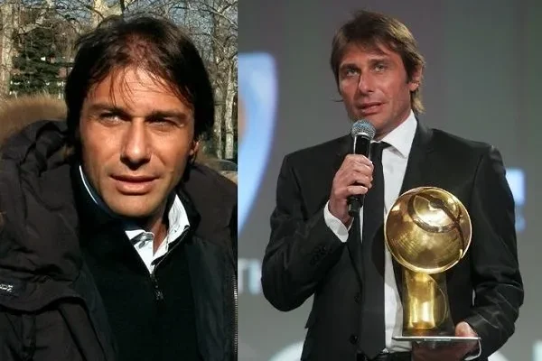 Trasplante capilar en deportistas famosos