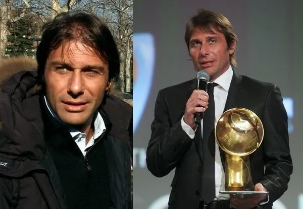 Trasplante capilar en deportistas famosos