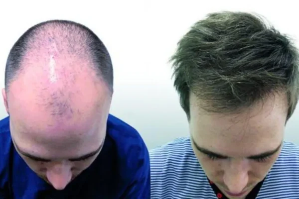 Comment se déroule une greffe de cheveux étape par étape en clinique