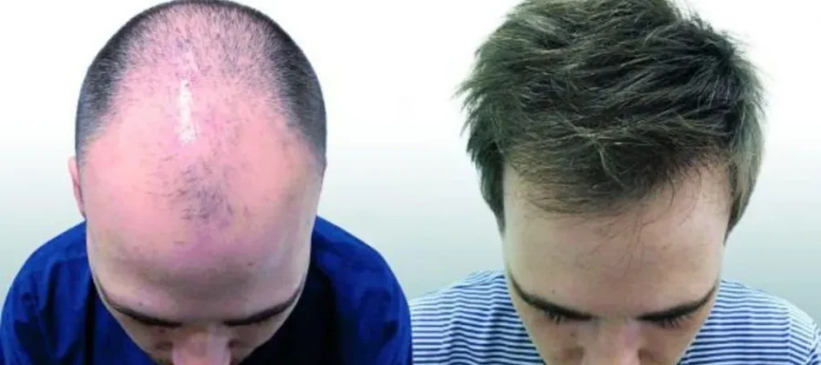 Comment se déroule une greffe de cheveux étape par étape en clinique 1 Comment se déroule une greffe de cheveux étape par étape en clinique