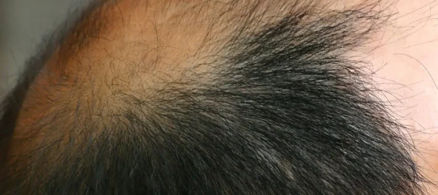 El trasplante de pelo FUE, la mejor opción contra la calvicie 1 El trasplante de pelo FUE, la mejor opción contra la calvicie