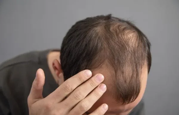 Se me cae el pelo: ¿qué hago?