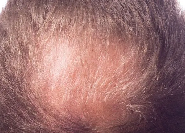 Causas de la pérdida de cabello