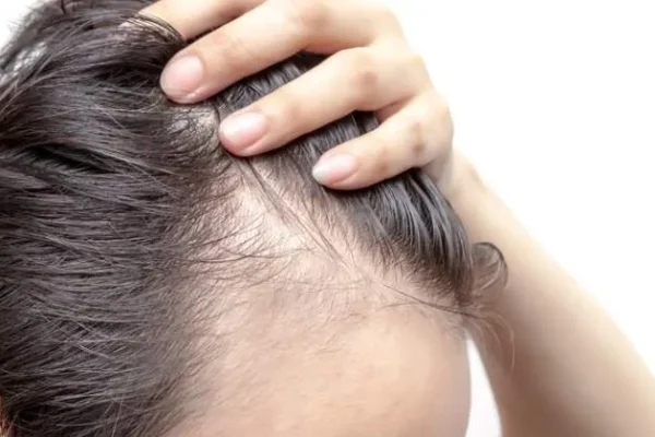 Dudas frecuentes sobre el trasplante de pelo