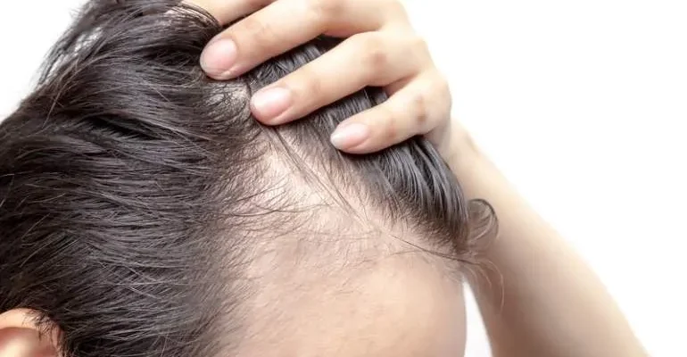 Dudas frecuentes sobre el trasplante de pelo 1 Dudas frecuentes sobre el trasplante de pelo