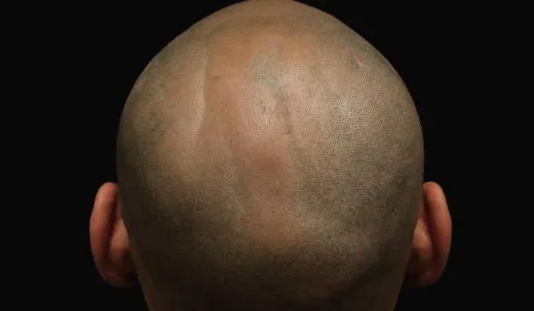 Questions et réponses essentielles sur la greffe de cheveux moderne