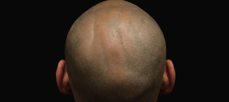 Questions et réponses essentielles sur la greffe de cheveux moderne 1 Questions et réponses essentielles sur la greffe de cheveux moderne