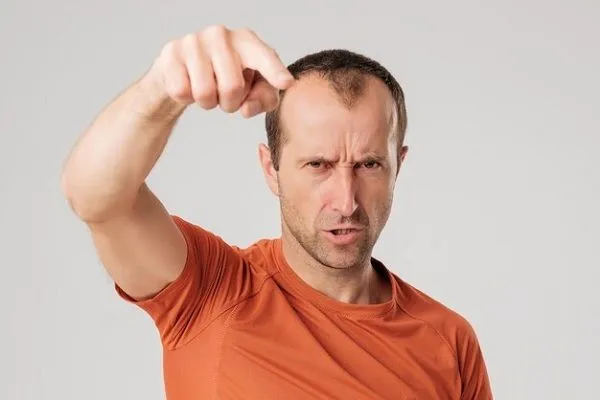 Je deviens chauve: que puis-je faire? 5 Je deviens chauve: que puis-je faire?