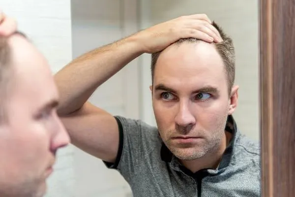 Je deviens chauve: que puis-je faire? 3 Je deviens chauve: que puis-je faire?