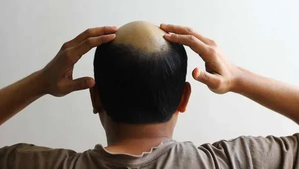 ¿Cómo recuperar el cabello perdido?