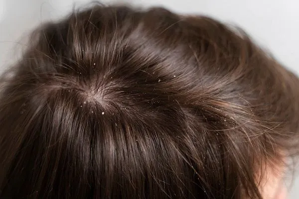 Cómo tratar la caspa en los hombres