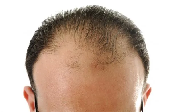 Trasplante de pelo y tratamientos capilares con células madre 1 Trasplante de pelo y tratamientos capilares con células madre