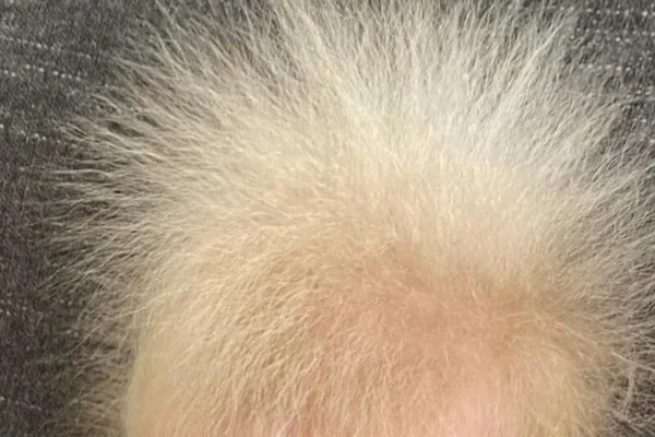 Syndrome des cheveux incoiffables