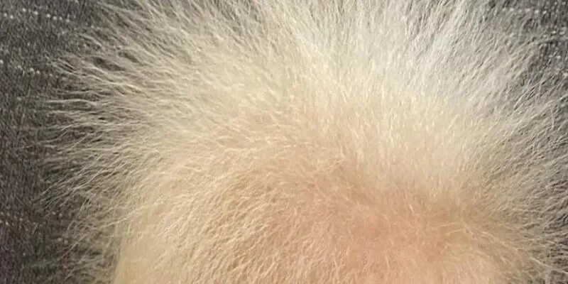 Syndrome des cheveux incoiffables 1 Syndrome des cheveux incoiffables