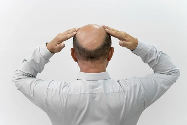 Perte de cheveux pendant la chimiothérapie