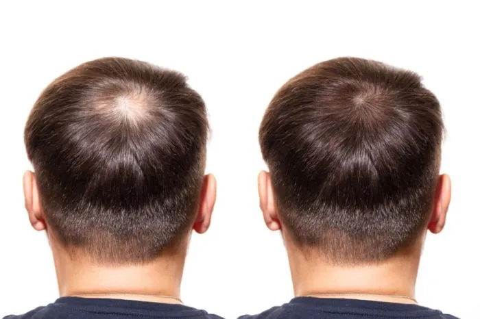 Causes de la chute des cheveux chez les hommes