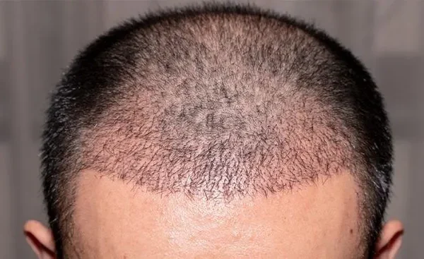 Causes de la chute des cheveux chez les hommes