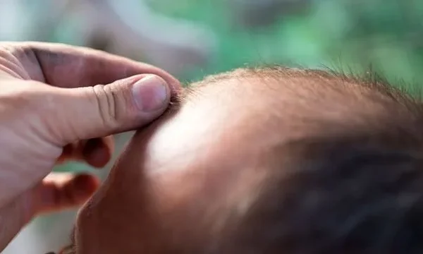 Consejos a tener en cuenta después del trasplante capilar: Medicación y práctica deportiva