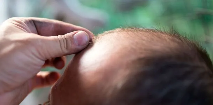 Consejos a tener en cuenta después del trasplante capilar: Medicación y práctica deportiva 1 Consejos a tener en cuenta después del trasplante capilar: Medicación y práctica deportiva