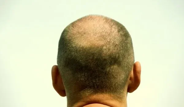 Razones por las que nuestro pelo deja de crecer