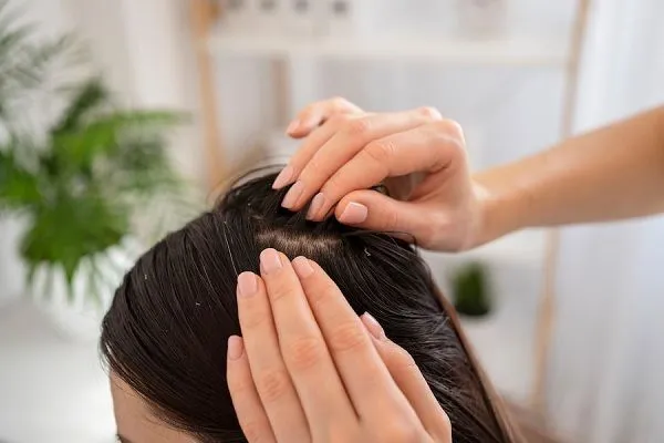 ¿Qué es la alopecia seborreica? 4 ¿Qué es la alopecia seborreica?